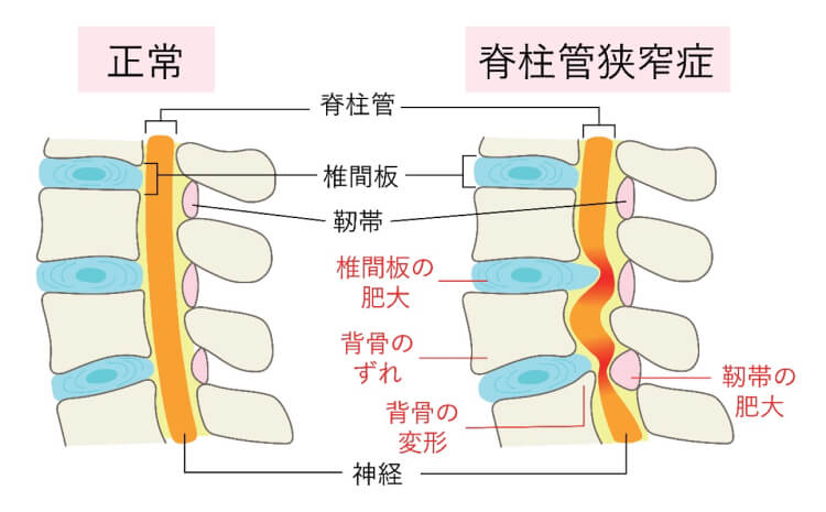 脊柱管狭窄症とは何か?