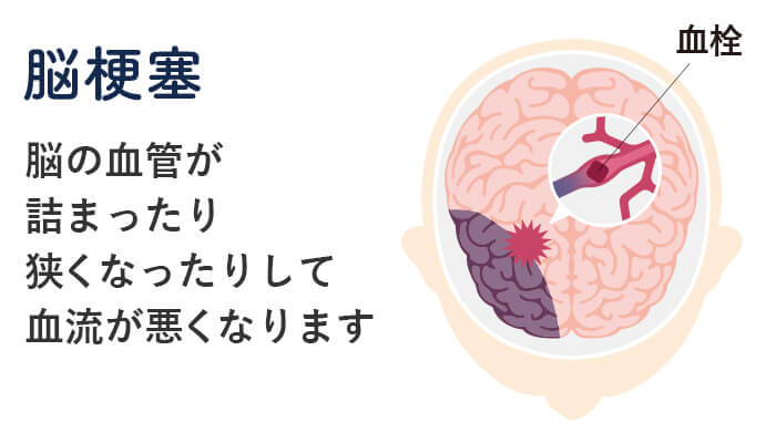 脳梗塞とは