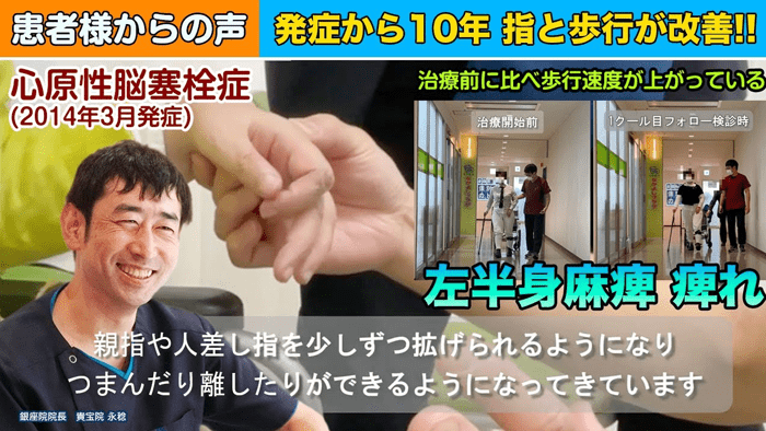 【50代女性｜心原性脳梗塞】発症後10年経過も指の動きと歩行に改善がありました！